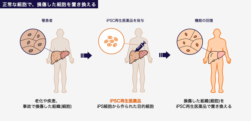 正常な細胞で、損傷した細胞を置き換える