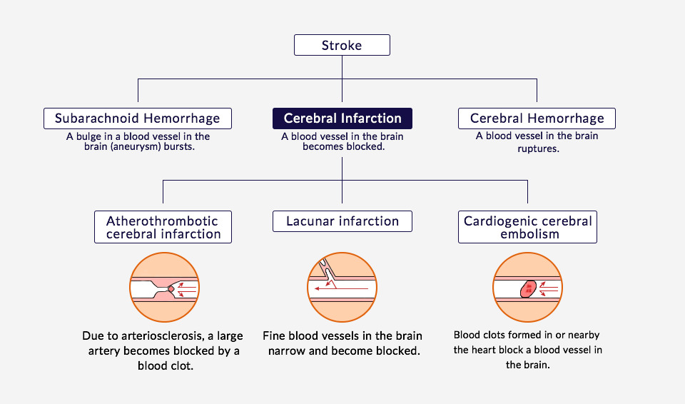 Types Of Cva Stroke