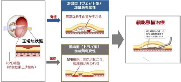 iPS細胞由来RPE細胞懸濁液を用いた加齢黄斑変性の治療法